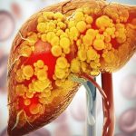 fatty_liver